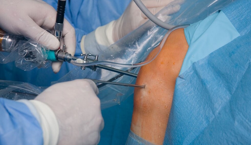 Latest Minimally Invasive Surgery Options In Orthopaedics Sports 