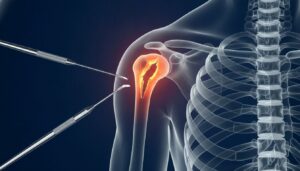 Expert Rotator Cuff Repair Near Belleville, NJ: Specialized Shoulder Care